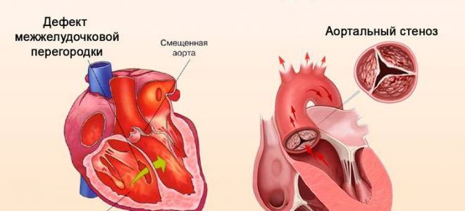 Тахикардия сердца: что это и как лечить