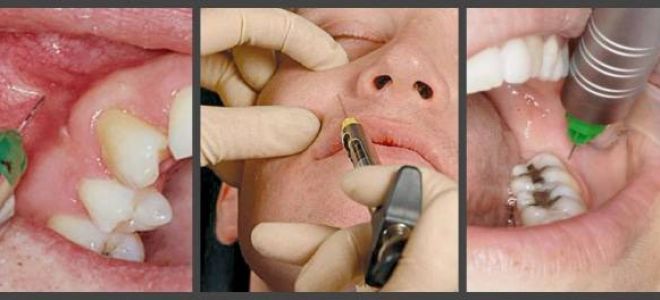 Чем опасен хронический гангренозный пульпит и как его лечить