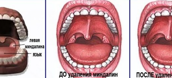 Хронический тонзиллит