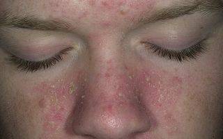 Причины появления и лечение себорейного дерматита сухого типа на лице