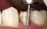 Подробно о том, как проводится депульпация зуба перед протезированием