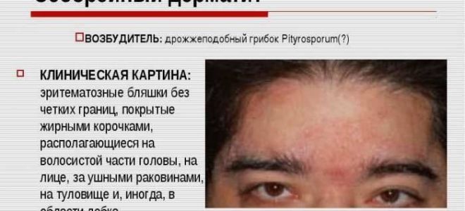 Какие таблетки пропить от себореи