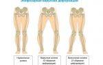 Саркома бедренной кости симптомы фото причины стадии диагностика лечение и прогноз