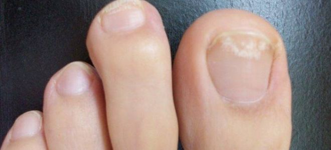 Начальная стадия грибка ногтей: фото