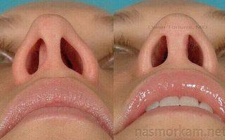 Искривление носовой перегородки: лечение без операции