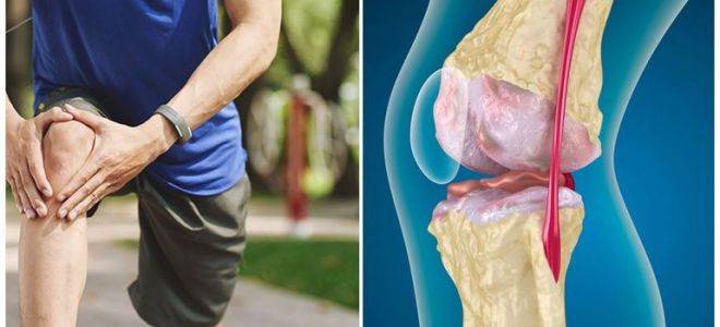 Эффективные методики лечения 1 стадии гонартроза