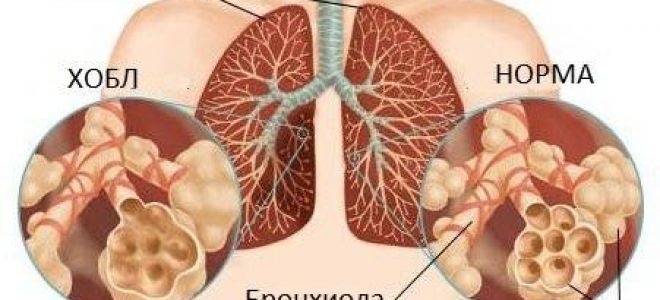 Хобл: причины, симптомы, диагностика и лечение