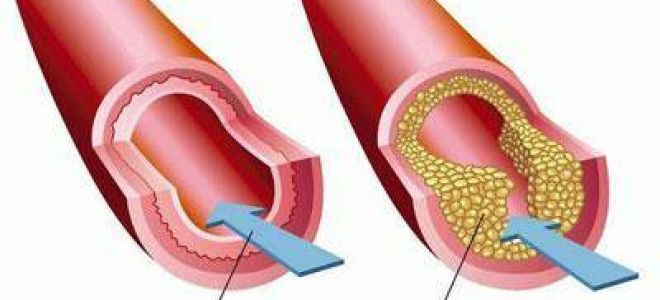 Тугоухость