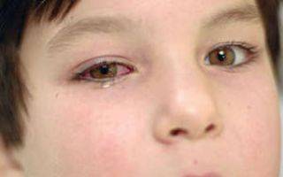 Когда и зачем капают препарат «сульфацил натрия» в нос детям?