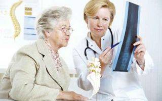 Остеопороз: симптомы и лечение у женщин после 50 лет
