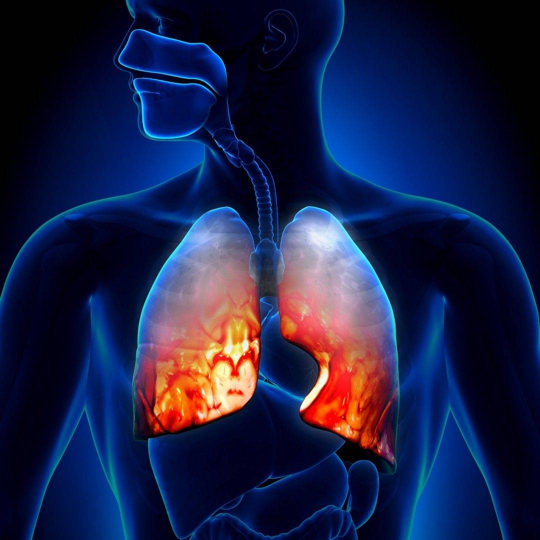 Пневмония у взрослых – виды, причины, признаки, диагностика и лечение
