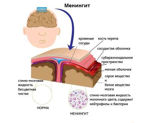 Как передается менингит бактериальный, вирусный или туберкулезный - инфицирование и профилактика