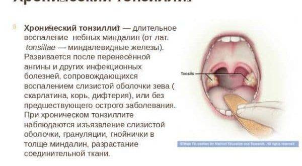 Больное горло при беременности влияние на плод