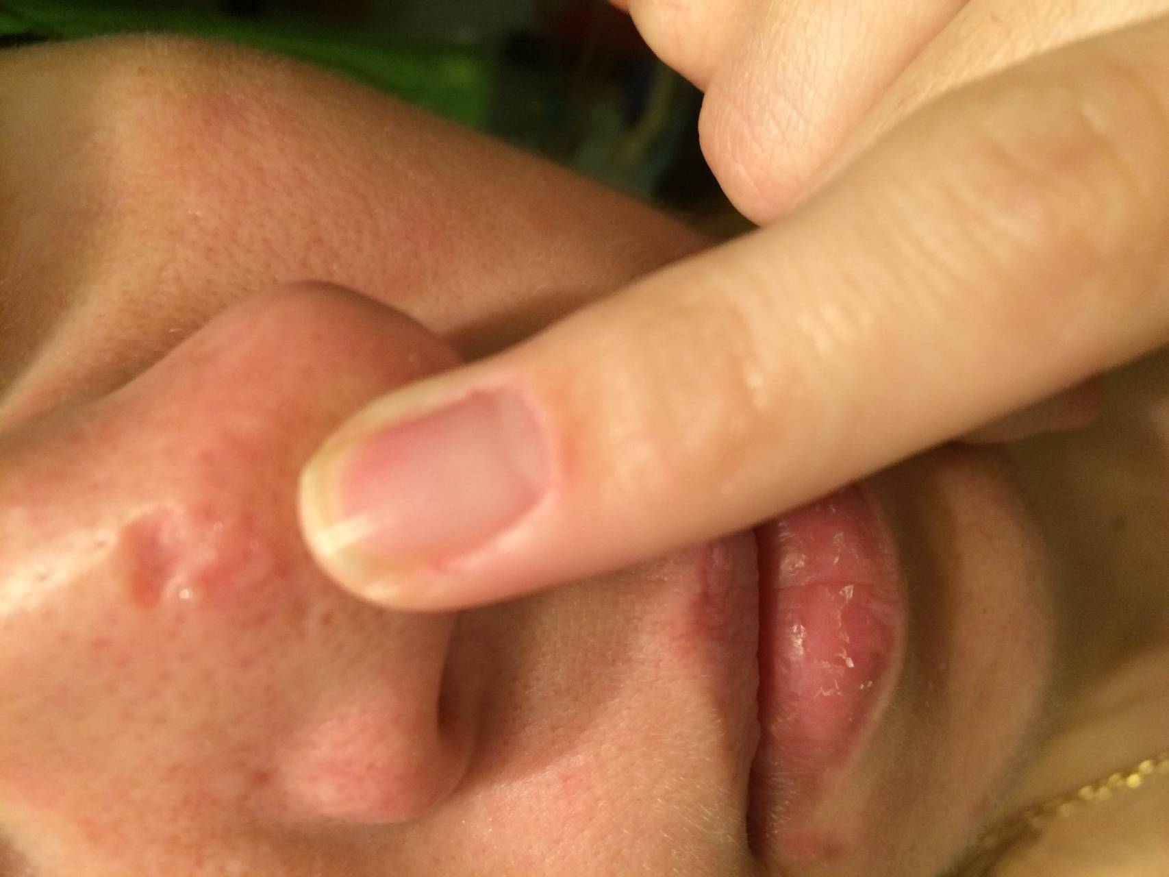 Мазь от болячек в носу – чем помазать ранки и простуду