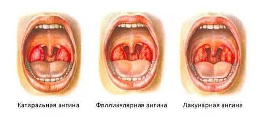 Катаральная ангина: фото миндалин, симптомы и лечение — чтобы горло не болело