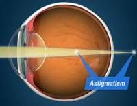 Астигматизм глаз: у детей и взрослых, лечение (очки, линзы), симптомы, виды, тесты на астигматизм