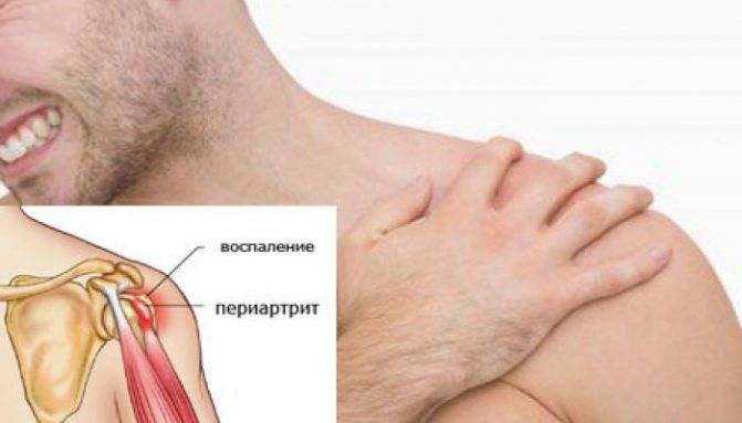 Плечевой полиартрит лечение народными средствами
