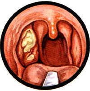 Ангина симановского венсана - язвенно-некротическая: лечение антибиотиками, гнойно