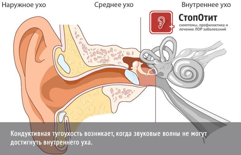 Нейросенсорная тугоухость: симптомы и лечение - сибирский медицинский портал