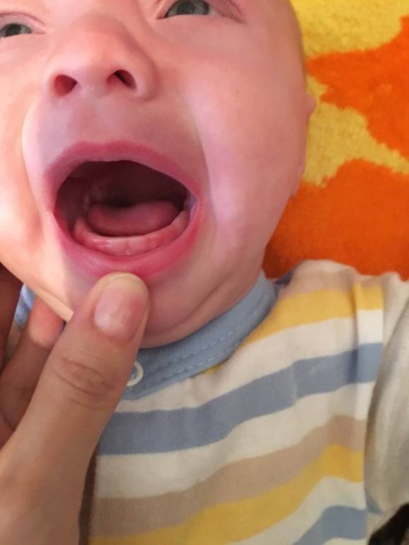Опасна ли рвота при прорезывании зубов у детей, и другие осложнения