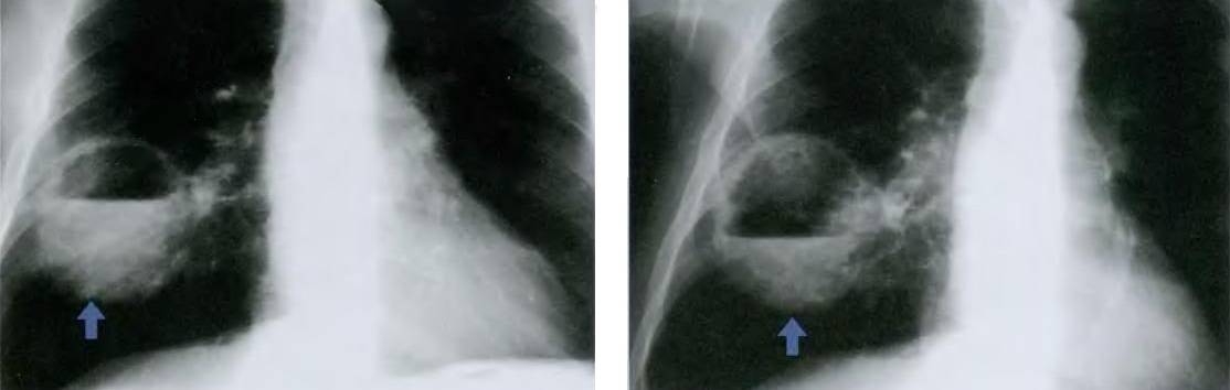 Абсцедирующая пневмония: причины, признаки, лечение