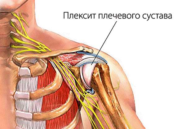 Симптомы и лечение плексита плечевого сустава, воспаления плечевого сплетения