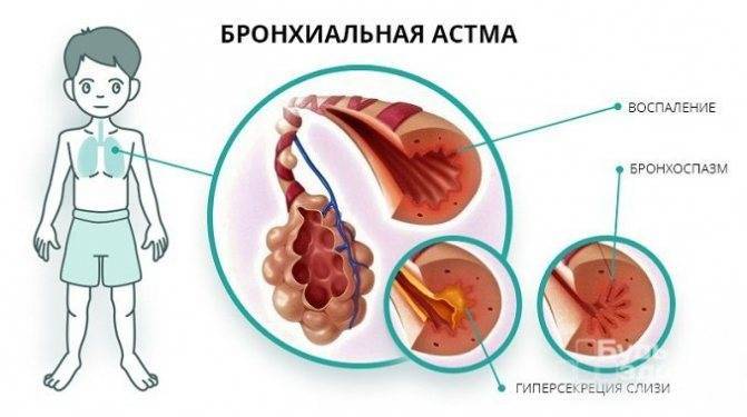 Кашлевая форма бронхиальной астмы: признаки и лечение у детей и взрослых