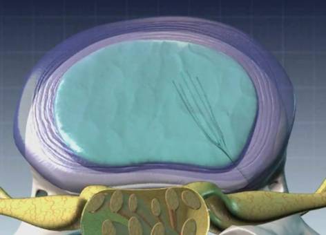 Нуклеопластика удаление грыжи межпозвонкового диска отзывы