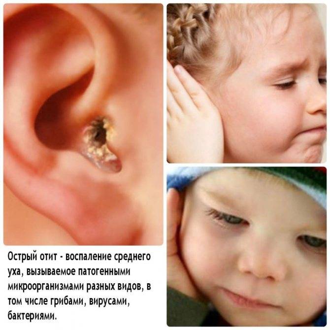 Отит среднего уха у ребенка: симптомы и лечение, особенности острой и катаральной, серозной, экссудативной и двусторонней форм, средства для лечения в домашних условиях