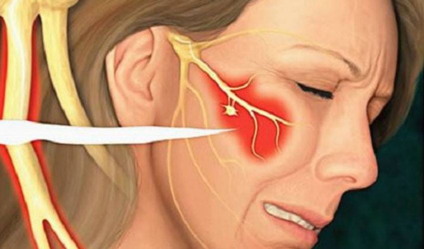 Неврит лицевого нерва: причины, симптомы и лечение