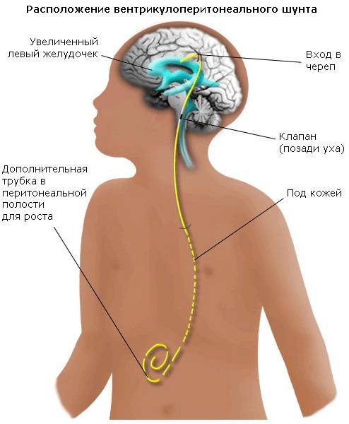 Причины, симптомы и лечение гидроцефалии или водянки головного мозга