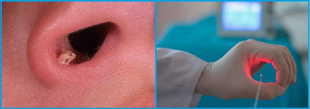 Как лечить полипы в носу — эффективное лечение народными средствами, без операций