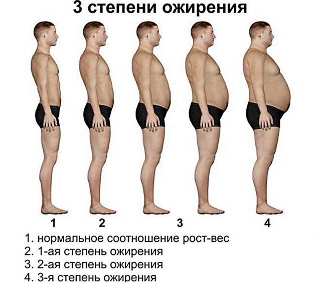 Алиментарное ожирение: конституциональное, экзогенное, генеза, 1 степени, что такое, у детей