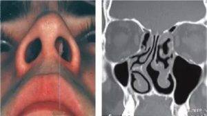 Искривление перегородки носа: причины появления, первые признаки и симптомы, последствия и лечение патологии