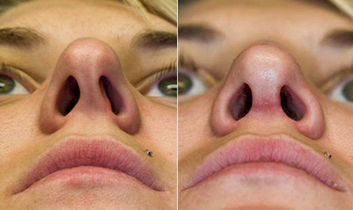 Последствия искривления носовой перегородки; лечение - yourlor