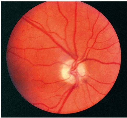 Частичная атрофия зрительного нерва и полная: что это такое, бывает ли на обоих глазах и как лечить