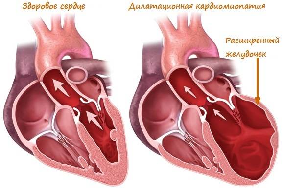 Дилатационная кардиомиопатия рекомендации