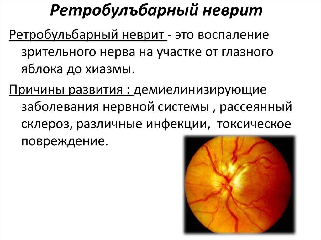 Частичная атрофия зрительного нерва: лечение, где можно вылечить, нисходящая, симптомы, у детей