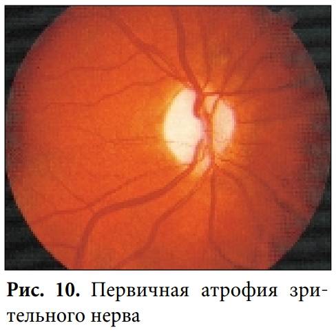 Атрофия зрительного нерва: симптомы, лечение и прогноз