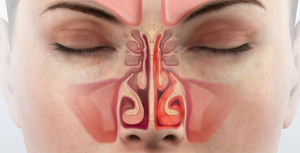Как лечить воспаление слизистой носа?