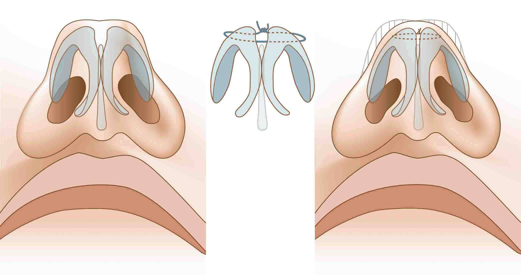 Лечение искривления носовой перегородки без операции