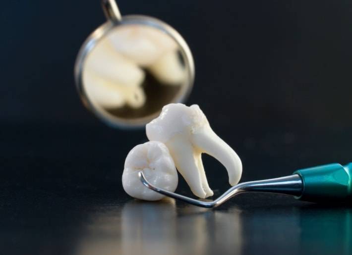 Депульпирование зуба перед протезированием — дезинфекция, подготовка под коронку