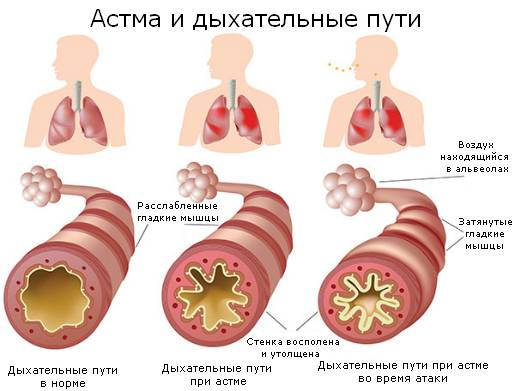 Бронхиальная астма у детей - первые признаки и проявление, формы и диагностика, симптомы и лечение
