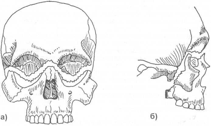 Переломы нижней челюсти, их классификация и лечение