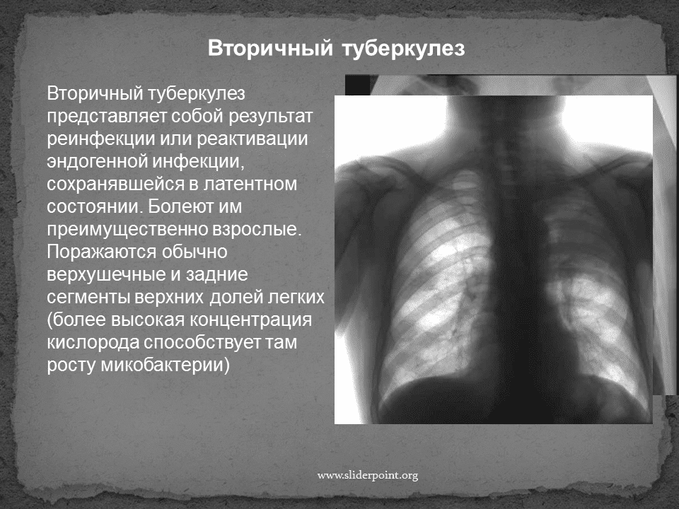 Туберкулез у новорожденных детей: лечение, причины, симптомы, признаки