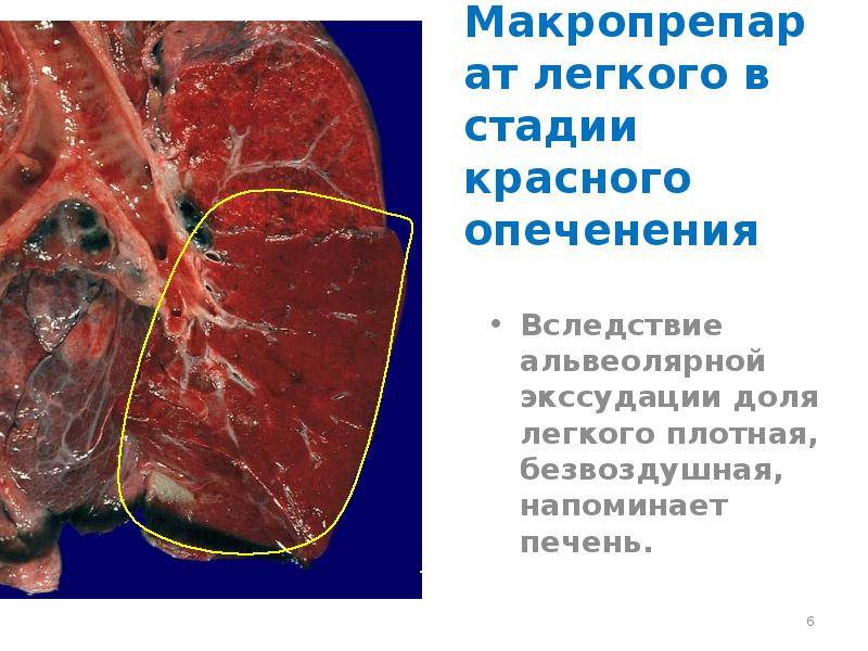 Стадии крупозной пневмонии – красное опеченение воспаления легких