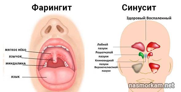 Болит горло при глотании с одной стороны (колющие и режущие ощущения)