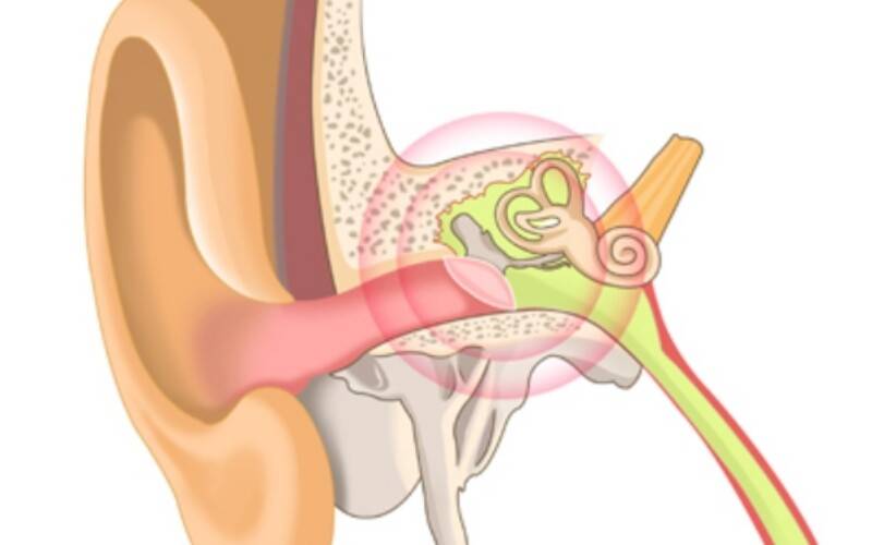 Экссудативный отит среднего уха у взрослых (серозный отит)