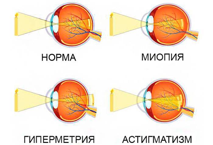 Как победить гиперметропический астигматизм: два способа вернуть зрение без операции