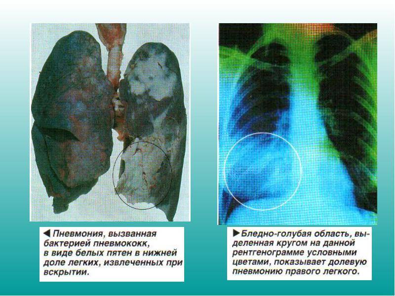Как отличить развивающийся рак легких от хронической пневмонии
